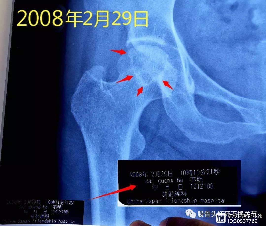 江西人工骨头医保报销多少(人工骨头医保报销多少比例)