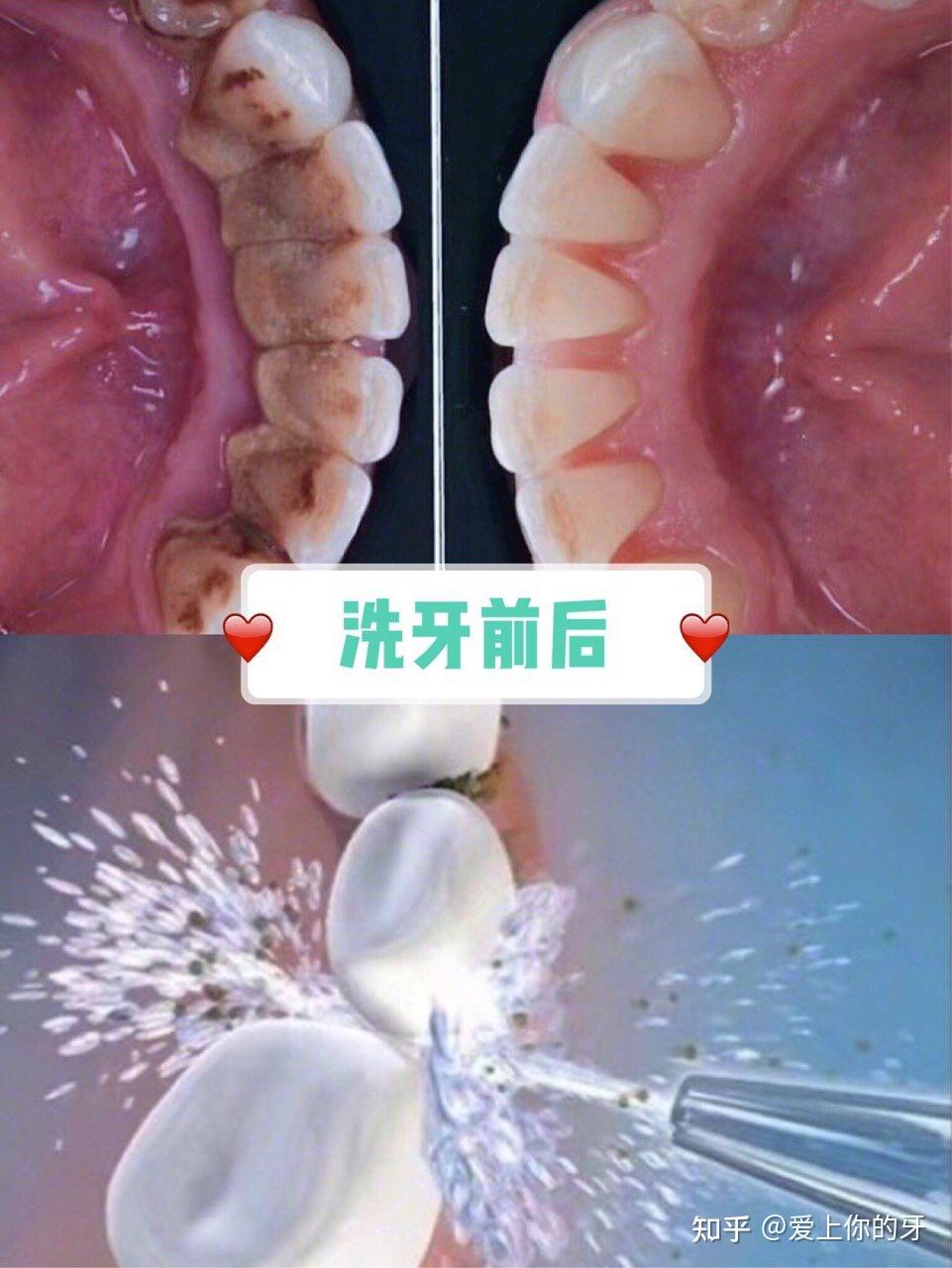 江西洗牙可以用医保吗(洗牙可以用医保吗,报销比例多少)